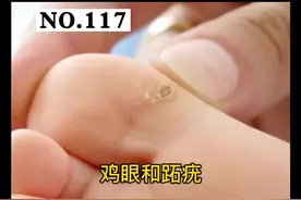 脚底长了#鸡眼 和#跖疣 ，很痛苦，怎么区别？怎么处理？#科普 视频封面