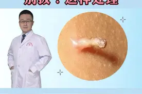 脖子上褐色小点点 小肉丁，除了影响美观，可能还会传染，怎么处理#丝状疣 #科普 #健康 视频封面