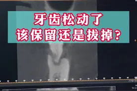 牙齿松动了，该保留还是拔掉？#爱护牙齿 #口腔科普 #牙齿健康 #小荷门诊爱牙 