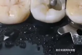 花了4000块才保留了这个烂牙，大家觉得值不值？#烂牙 #根管治疗 #打桩 #口腔科普 #口腔科邓教授 视频封面