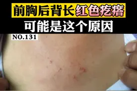 前胸后背长#痘痘 ，非常影响美观，这可能是#毛囊炎 ，可以这样做#科普 #真菌 视频封面