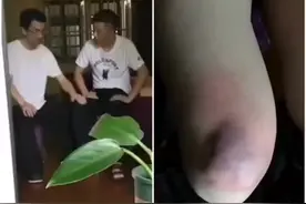 传说中的“老寒腿”，拍打几下膝盖出来个大“瘀包”视频封面