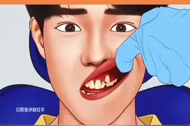 虎牙长在牙龈上怎么矫正#口腔健康 #爱牙护牙 #解说 #矫正牙齿 #医美视频封面
