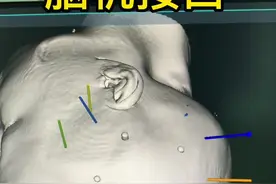脑机接口：手术机器人在脑部植入脑深部电极后，连接体外脑电记录分析仪器，记录脑电活动情况（人体所有活动都是脑电指令控制）根据结果明确脑内病变范围，对病变进行毁损或者切除，达到治愈疾病目的#脑机接口 #癫痫 #赵成斌医生视频封面
