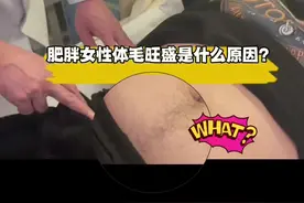 肥胖女性体毛旺盛是什么原因？#减重手术 #健康减肥 #多囊减肥