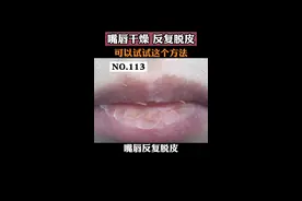 嘴巴一直反复脱皮，又干又痛，可以试试这样处理。#唇炎 #医学科普 视频封面