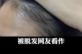 #发际线后移，#发缝越来越宽 ，别担心，皮肤科医生手把手教你长回来#掉发 视频封面