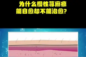 为什么慢性荨麻疹不能治愈，而能够自愈？#宅春节涨知识 #医学科普 #荨麻疹 @DOU+小助手视频封面