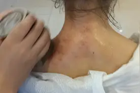 颈椎病是指颈椎间盘退行性变视频封面