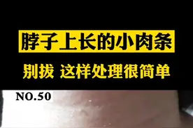 脖子上长了很多丝状的小肉丁，这个是#丝状疣 ，别拔了，教你一招简单处理#医学科普 