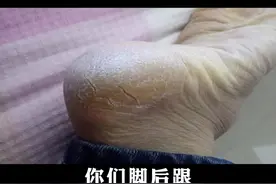 不是每一只脚干裂都是干燥引起，可能是真菌感染。#孕期 #妈妈 #脚臭 #脚后跟干裂 视频封面