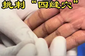 #四缝穴 #四缝穴点刺 #针灸#曹方针灸工作室
