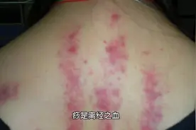 痧是什么？痧是离经之血，必须要排掉的废血#养生 @视频封面