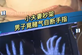 夫妻吵架，男子竟赌气自断手指！小指后两节被完全切断#福建dou知道视频封面