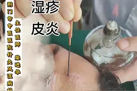 湿疹 火针多多少少有点痛#火针 #湿疹 #中医 #皮炎视频封面