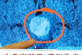 十几岁孩子 反复头疼 巨大动脉瘤？ #十几岁孩子 #反复头疼 #巨大动脉瘤 #医学科普 #硬核健康科普行动视频封面