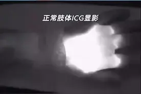 吲哚菁绿（ICG）淋巴管显像是一种简单、微创的淋巴管功能检查方法，在淋巴水肿分度诊断、手术方案制定、手术切口设计等诊疗过程中被广泛应用。视频封面