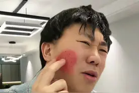 春季气温上升隐翅虫活跃， 遇到“会飞的浓硫酸”，千万不要拍！#隐翅虫 #不要用手拍隐翅虫 #隐翅虫的危害 #注意防范 #内容启发搜索视频封面