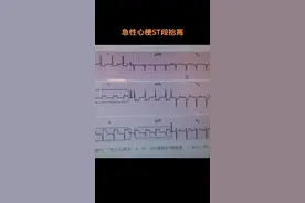 急性心梗、ST段抬高、心电图