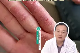 秋冬季节，手上这种干裂，不是冻疮，而是角化型湿疹！#角化型湿疹 #手脚干裂涂什么好 #硬核健康科普行动 #健康冷知识知多少视频封面