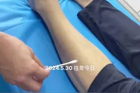 常见交麻 #脚麻 #腰椎间盘突出