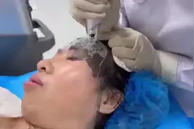 #胎记 #胎记去除 #鲜红斑痣 激光过程中～视频封面