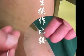 #中医针灸 #随手拍 #董氏奇穴 #奇穴奇效 #师带徒视频封面