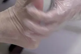 #鸡眼 #拇趾外翻    鸡眼不是贴鸡眼膏就能好的   鸡眼分为因拇趾外翻后脚趾畸形，骨性突出压迫摩擦引起的，还有一种是没有收到物理刺激的皮肤角质过度增生，这一类属于皮肤病范畴。 拇趾外翻引起的鸡眼，单纯处理鸡眼胼胝体会反复发作，需要先处理脚趾畸形，鸡眼才不会反复发作视频封面