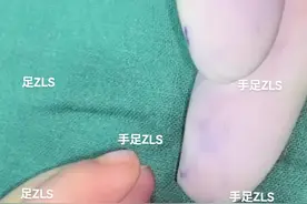 复拇指，1型，对称型。 治疗方案：手指拼合。20240219 #复拇指 #多指 #拇指发育不良 #并指