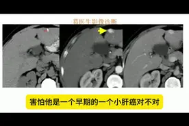 CT发现肝脏低密度灶，你有些害怕视频封面
