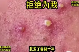 #超爆小故事 #一口气看完系列 #解压挤痘痘 #强迫症治愈系视频封面
