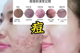 #上热门 揭秘 | 痘痘形成的原因✅ 脸上不同的位置长痘💢