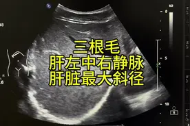 #超声学习 #b超 #超声影像 #每天跟我涨知识 #慕容超声