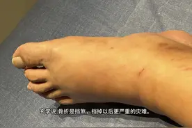 玄学说:骨折是挡煞，挡掉以后更严重的灾难。老人说:骨折也是转运视频封面