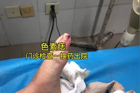 今天换药，办理出院。 总共历时5天。 出院证给出的诊断是色素痣