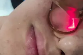 #痤疮 #点阵激光 #痘坑  点阵激光治疗痘坑🥼👨‍⚕️视频封面