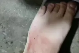 当自己不知道什么咬伤，可能延误治疗，错过最佳时间或者浪费很多钱，而且不一定有效果，延误治疗可能截肢，好人一生平安#蛇类科普#眼镜蛇咬伤