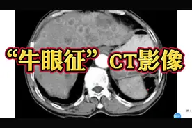 肝脏“牛眼征”CT表现分享，常见于什么疾病？医生讲解！