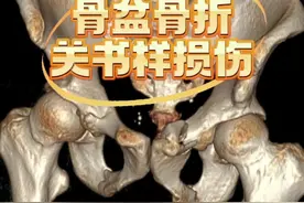 #骨科 #医学影像 #骨盆 骨盆骨折关书样损伤视频封面