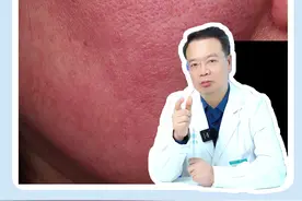 玫瑰痤疮仅靠照光就能快速见效？黄红光治玫瑰的底层逻辑你知道吗？ #在抖音pick你的健康搭子 #解锁春日健康清单 #抖出健康知识宝藏 #皮肤科医生谢红付 #医疗健康创作训练营