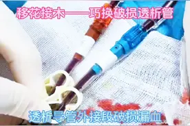 猜你没见过——移花接木——巧换破损透析导管外接段。#血管通路 #透析导管视频封面