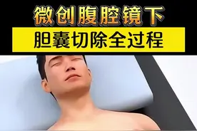 微创腹腔镜下胆囊切除全过程 #生活常识 #胆囊结石 #胆囊切除 #胆囊癌 #肿瘤医生江一博 安康市人民医院肿瘤科&安康市看肿瘤&安康市医院视频封面