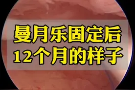 曼月乐缝合固定后一年的宫腔是什么样？#宫腔镜 #曼月乐 #医学科普 #医学科普仅供参考如有不适请线下就医视频封面