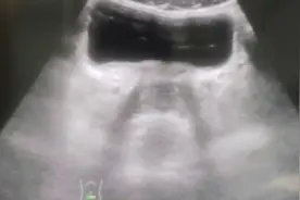 一招教你扫查前列腺#医学科普 #超声影像