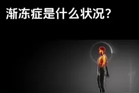 感悟研究渐冻症#渐冻症#渐冻症是怎么引起的 #医学科普