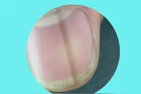 你有没有注意到甲变色 #甲母痣 #甲病 #医学科普仅供参考视频封面