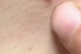 蜱虫在我国分布广泛，其中湖北、山东、安徽、河南等省份是蜱虫病的主要分布区，每年的4-10月是该病的集中发病期。该病的主要感染群体则在农村，因为蜱虫主要蛰伏在浅山丘陵地带的草丛和植物上，农民在下地干活时就很容易被蜱虫叮咬。2010年7月，河南省商城县曾发生过一起大面积蜱虫叮咬致死事件，其中有94.2%的患者都是农民。“蜱虫病”病死率可达32.6%，大家一定要加强防范，如果被咬，要及时就医。 视频资料来源于《河南发布》公众号。视频封面