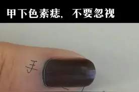 甲下色素痣，不要忽视了。如果发现，请尽快就医。#甲母痣 #色素痣 #黑色素瘤 #甲下色素沉着