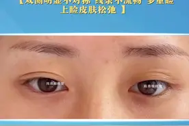 #埋线双皮眼 修复 不适当的埋线会有很多后顾之忧#双眼皮修复 #眼修复医生陈勇 #医学科普视频封面