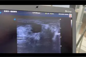 #乳腺结节 #微创手术 这是乳房结节微创手术的一个大概过程， 局部浸润麻醉后，预估好进针位置进针，超声引导下将旋切刀进到肿块的正下方之后开始旋切，在旋切过程中同时负压抽吸，对于出血渗出都可吸出，旋切结束后病灶一条一条取下来。加压包扎48～72小时。#硬核科普健康行动 #手术过程 #医学科普视频封面